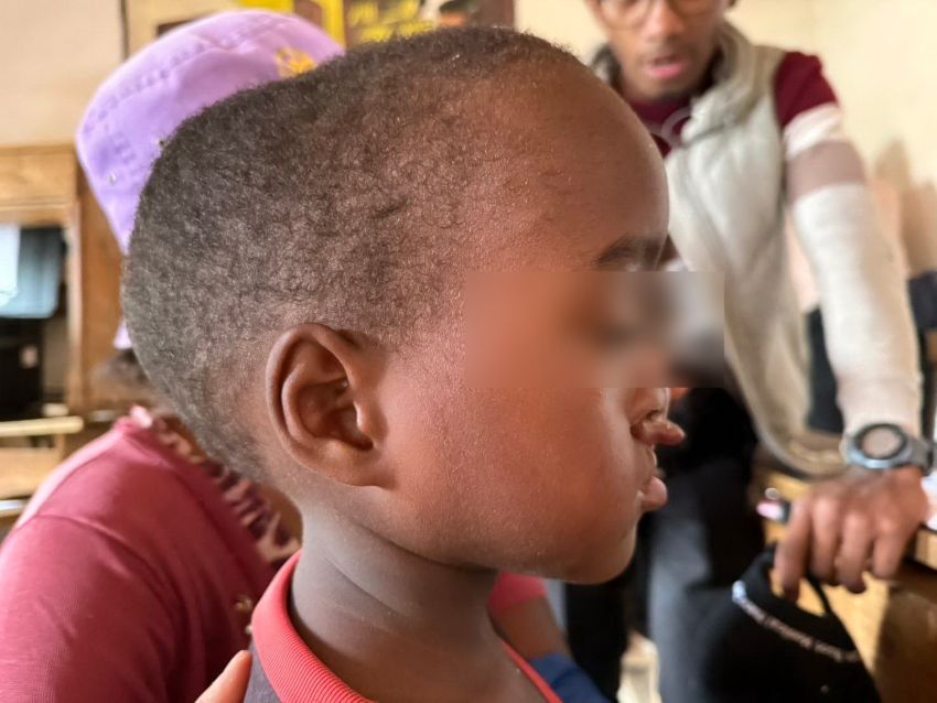 《圖說》病童小扎將安排於27日由台北醫學大學附設醫院顱顏中心主任陳國鼎重建手術。〈台灣路竹會提供提供〉